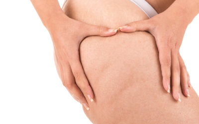 Cellulite: Causes and Treatments