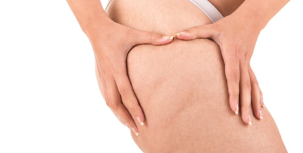Cellulite: Causes and Treatments